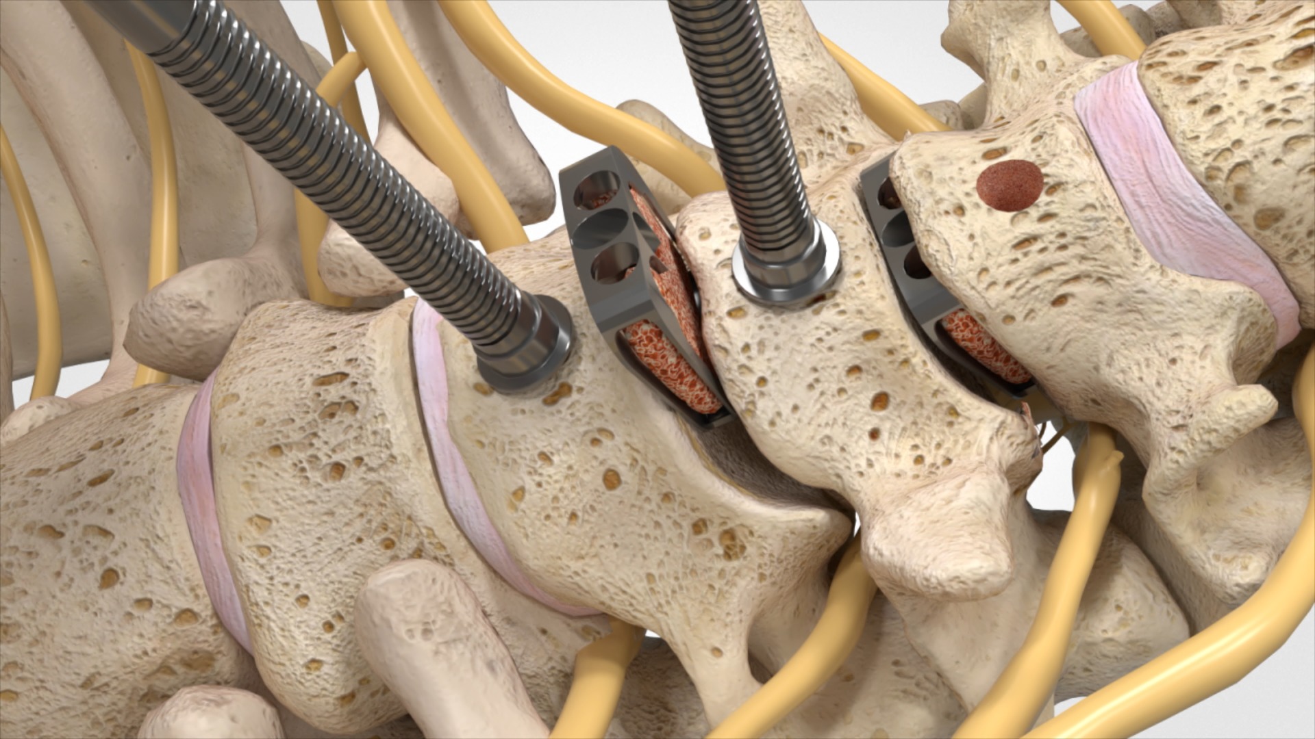 Spinal Cord Injury