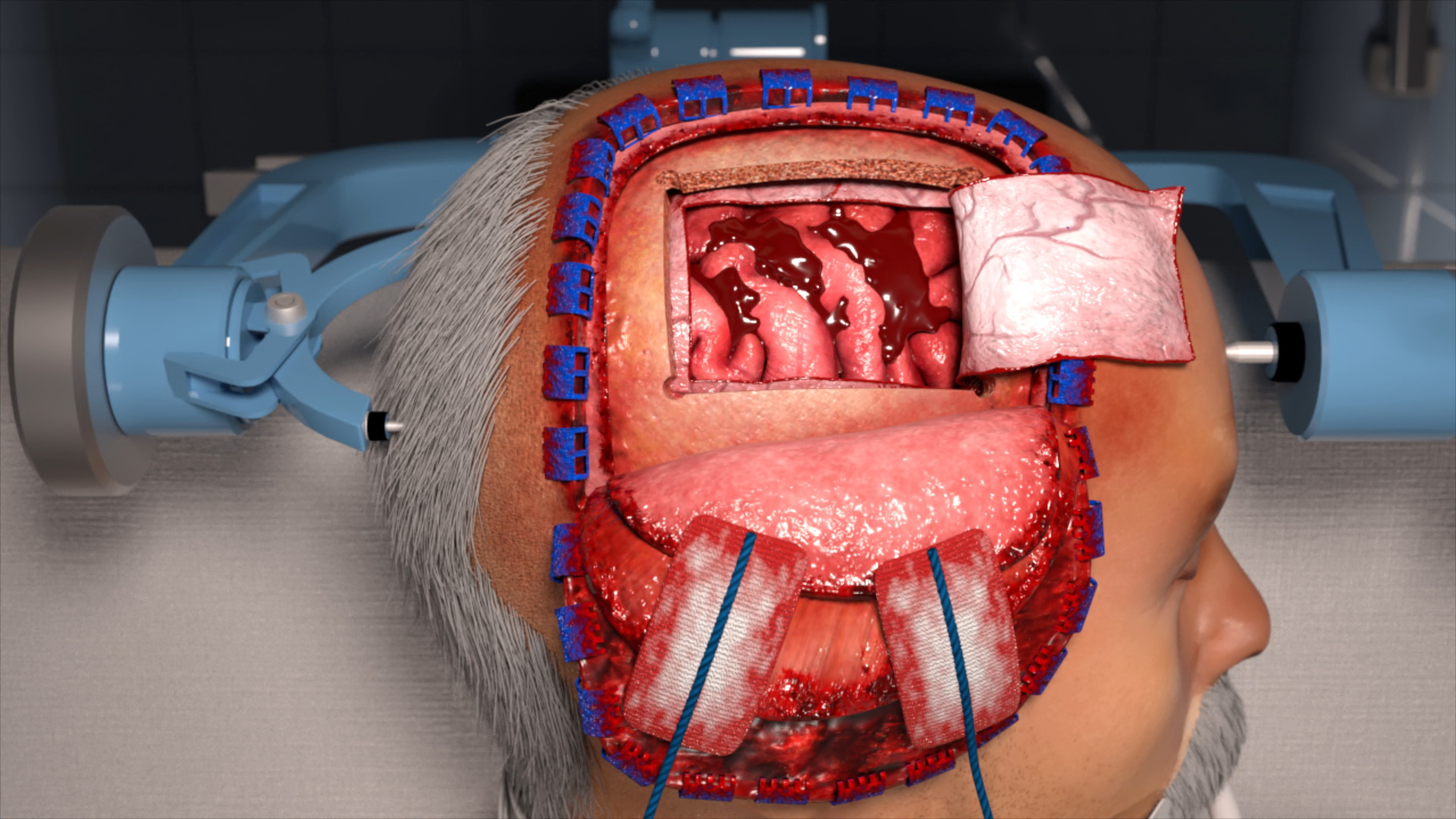 Surgical Procedure